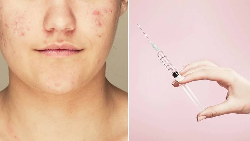 Sivilceye karşı iki aşı geliştiriliyor; mRNA denemesi ve enzim hedefli yaklaşım